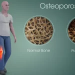 Osteoporosis