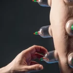 Cupping for Fibromyalgia And Arthritis